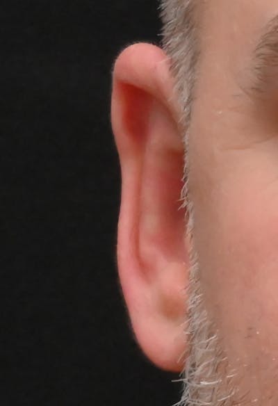 Otoplasty Before & After Gallery - Patient 399752 - Image 2