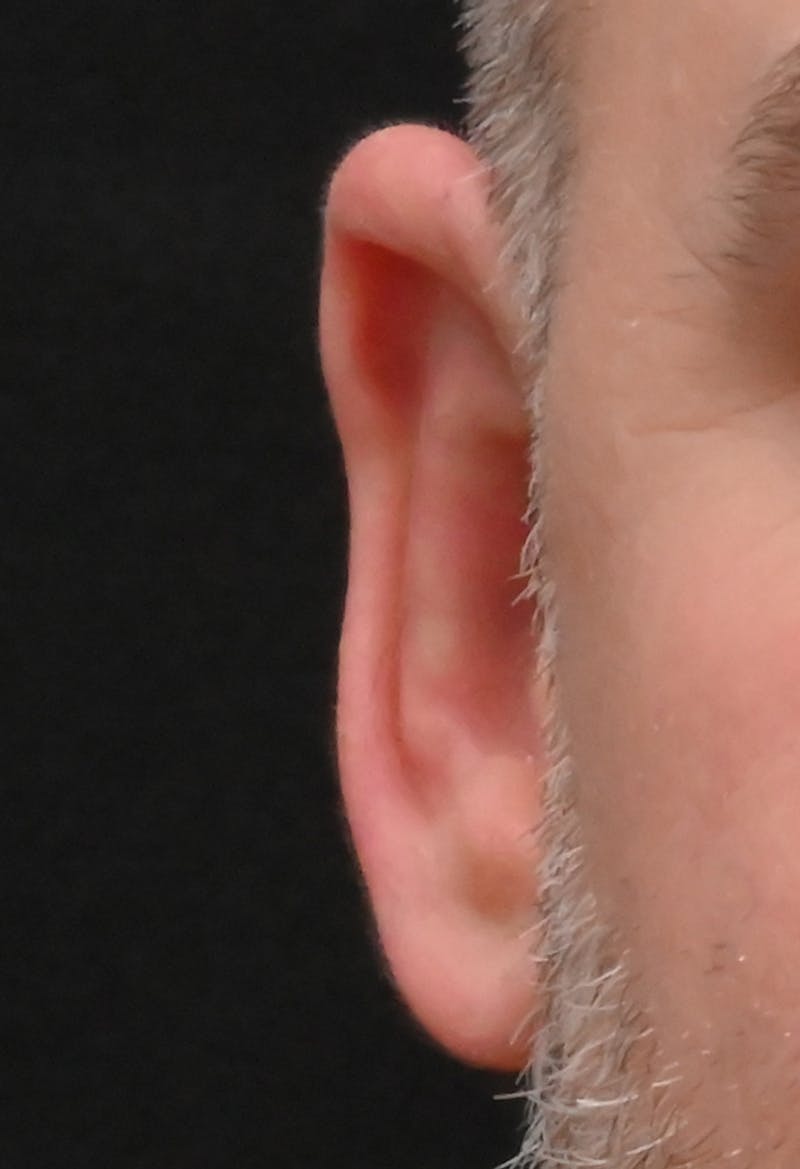 Otoplasty Before & After Gallery - Patient 399752 - Image 2