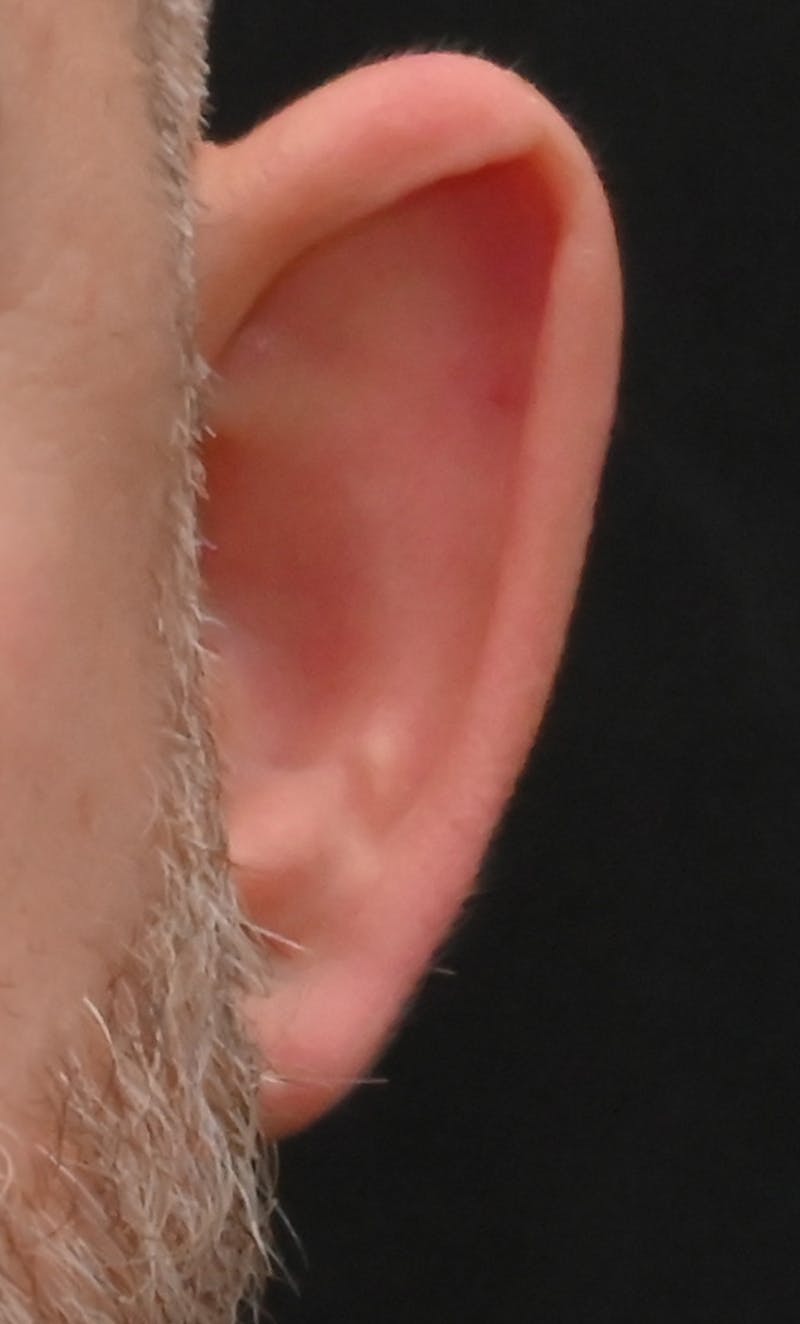 Otoplasty Before & After Gallery - Patient 399752 - Image 3