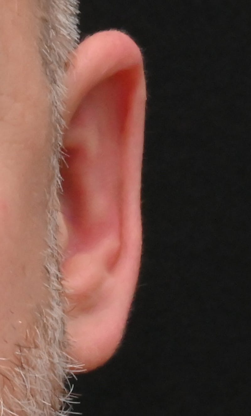Otoplasty Before & After Gallery - Patient 399752 - Image 4