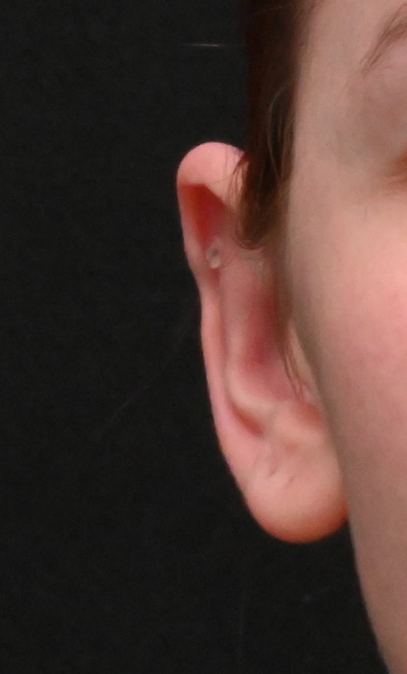 Otoplasty Before & After Gallery - Patient 739850 - Image 2