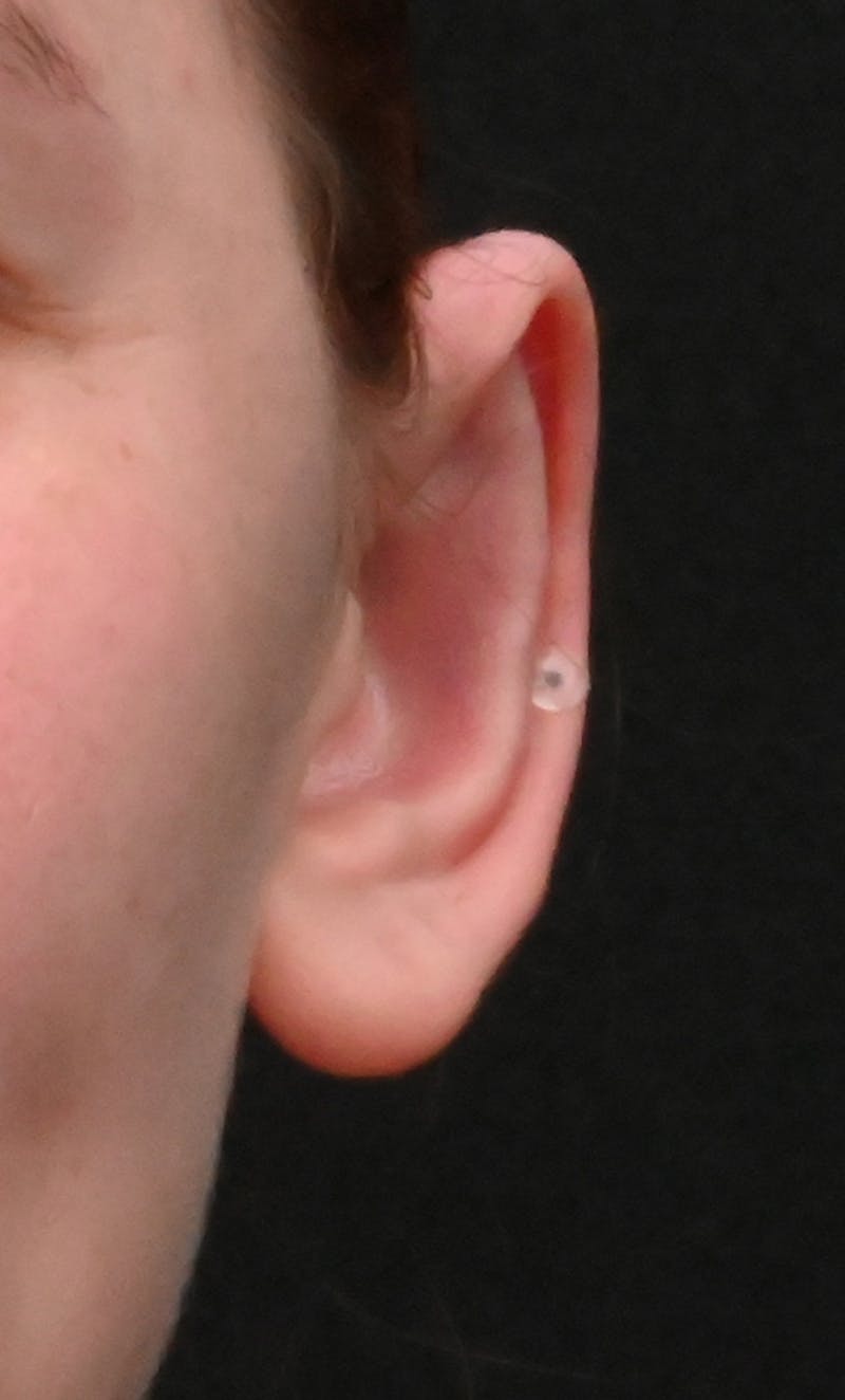 Otoplasty Before & After Gallery - Patient 739850 - Image 4