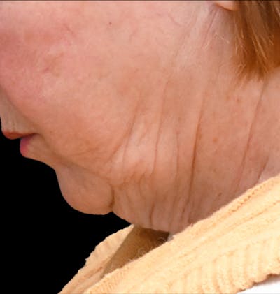 Deep Plane Facelift & Neck Lift Before & After Gallery - Patient 690244 - Image 1