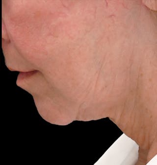 Deep Plane Facelift & Neck Lift Before & After Gallery - Patient 690244 - Image 2