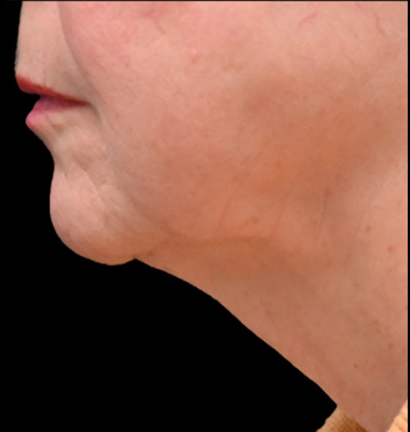 Deep Plane Facelift & Neck Lift Before & After Gallery - Patient 690244 - Image 3