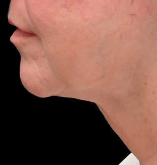 Deep Plane Facelift & Neck Lift Before & After Gallery - Patient 690244 - Image 4