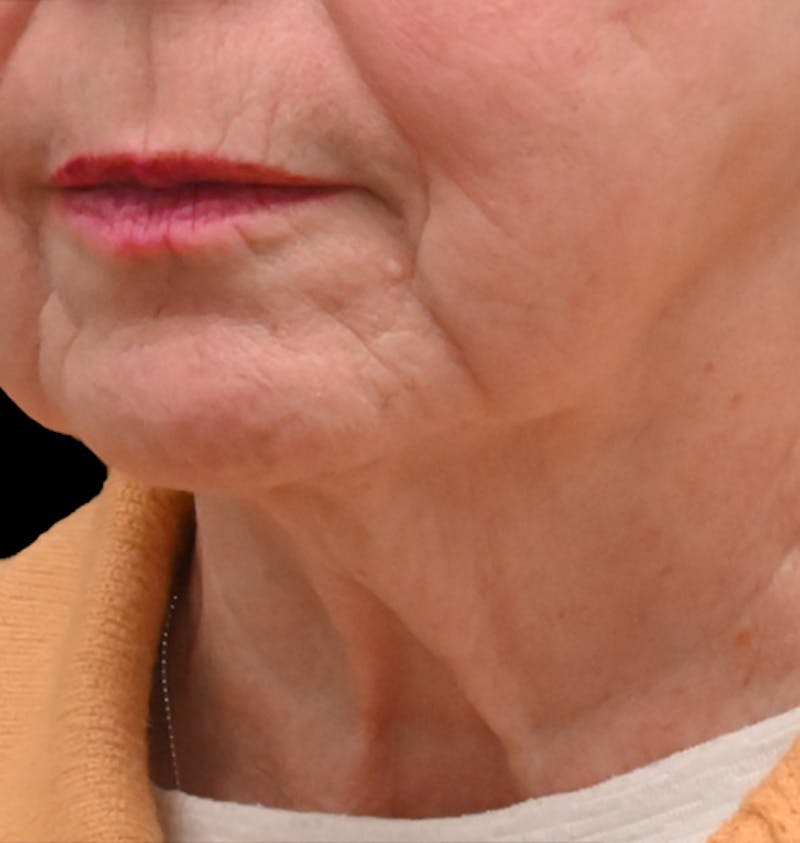 Deep Plane Facelift & Neck Lift Before & After Gallery - Patient 690244 - Image 5