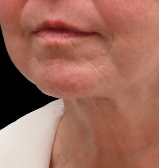 Deep Plane Facelift & Neck Lift Before & After Gallery - Patient 690244 - Image 6
