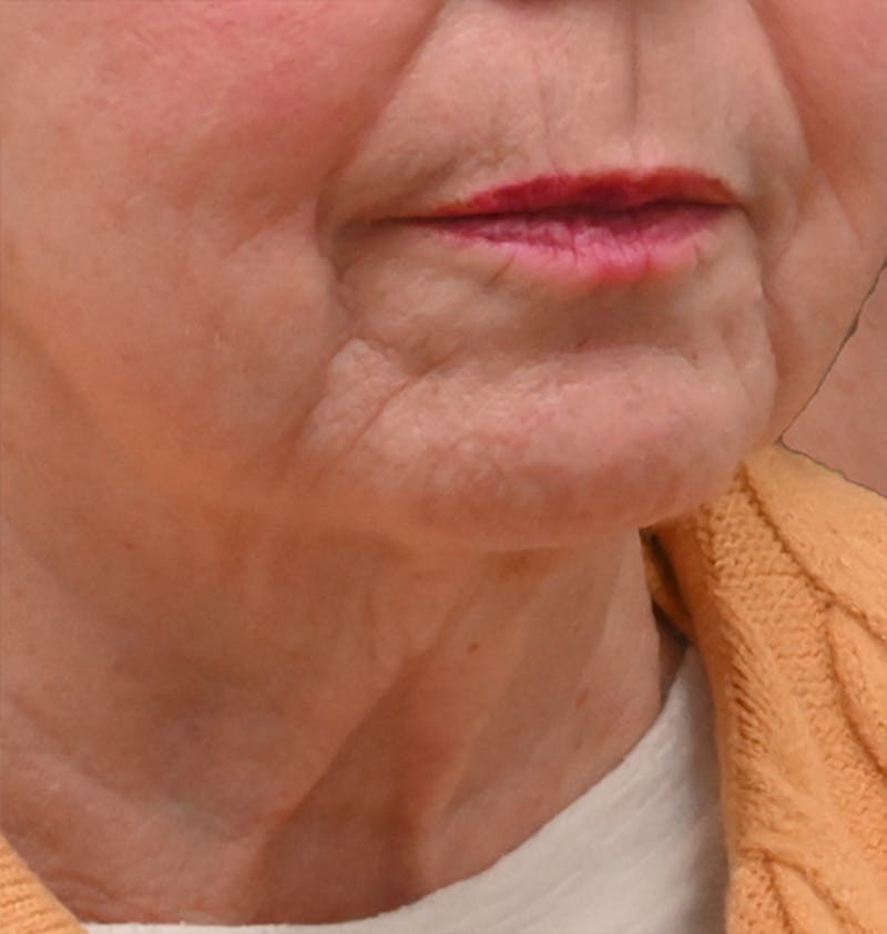 Deep Plane Facelift & Neck Lift Before & After Gallery - Patient 690244 - Image 7
