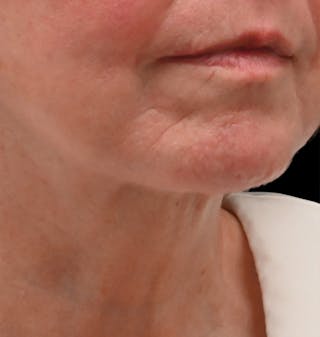 Deep Plane Facelift & Neck Lift Before & After Gallery - Patient 690244 - Image 8