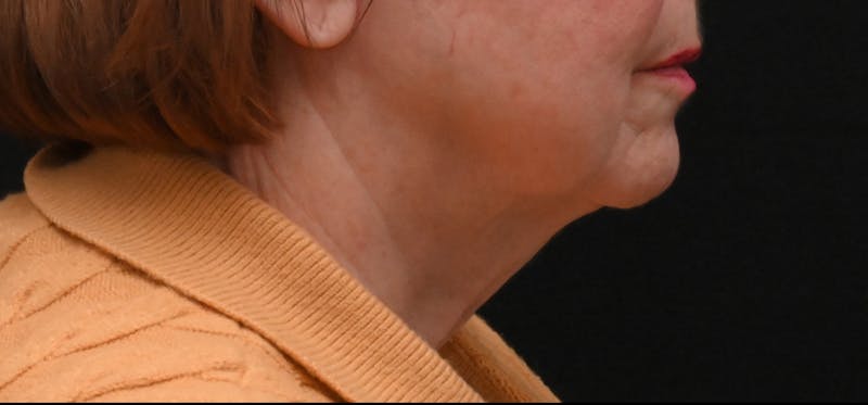 Deep Plane Facelift & Neck Lift Before & After Gallery - Patient 690244 - Image 9