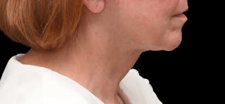 Deep Plane Facelift & Neck Lift Before & After Gallery - Patient 690244 - Image 10