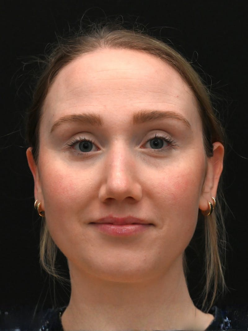 Rhinoplasty Before & After Gallery - Patient 504197 - Image 2