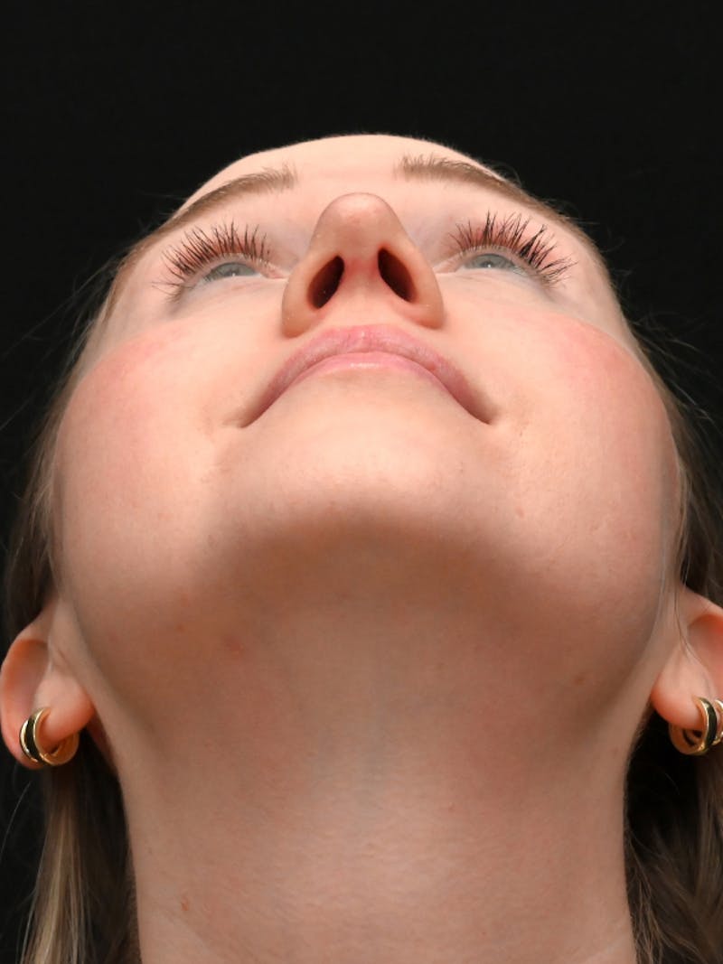 Rhinoplasty Before & After Gallery - Patient 504197 - Image 14