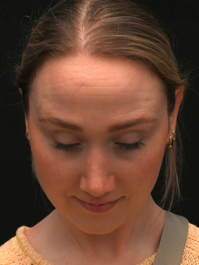 Rhinoplasty Before & After Gallery - Patient 504197 - Image 16