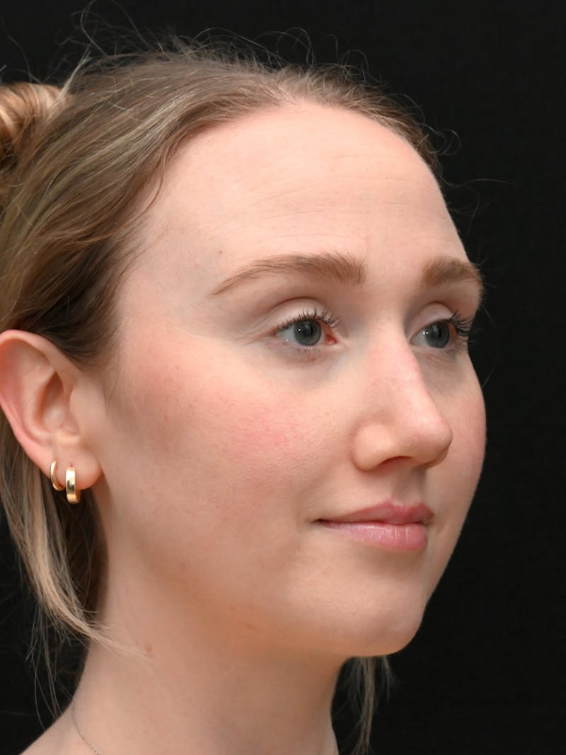 Rhinoplasty Before & After Gallery - Patient 504197 - Image 8