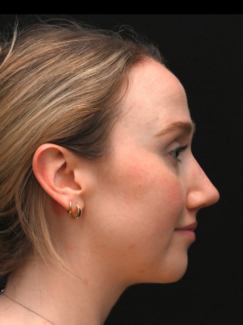 Rhinoplasty Before & After Gallery - Patient 504197 - Image 10
