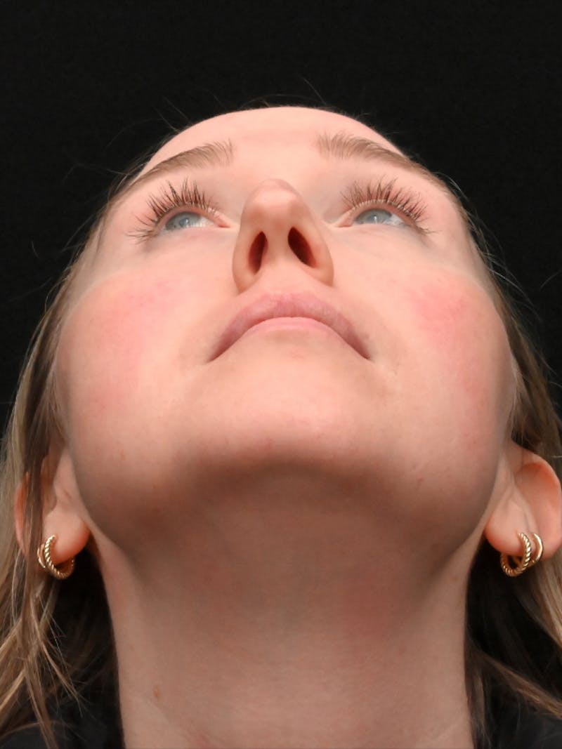 Rhinoplasty Before & After Gallery - Patient 504197 - Image 13