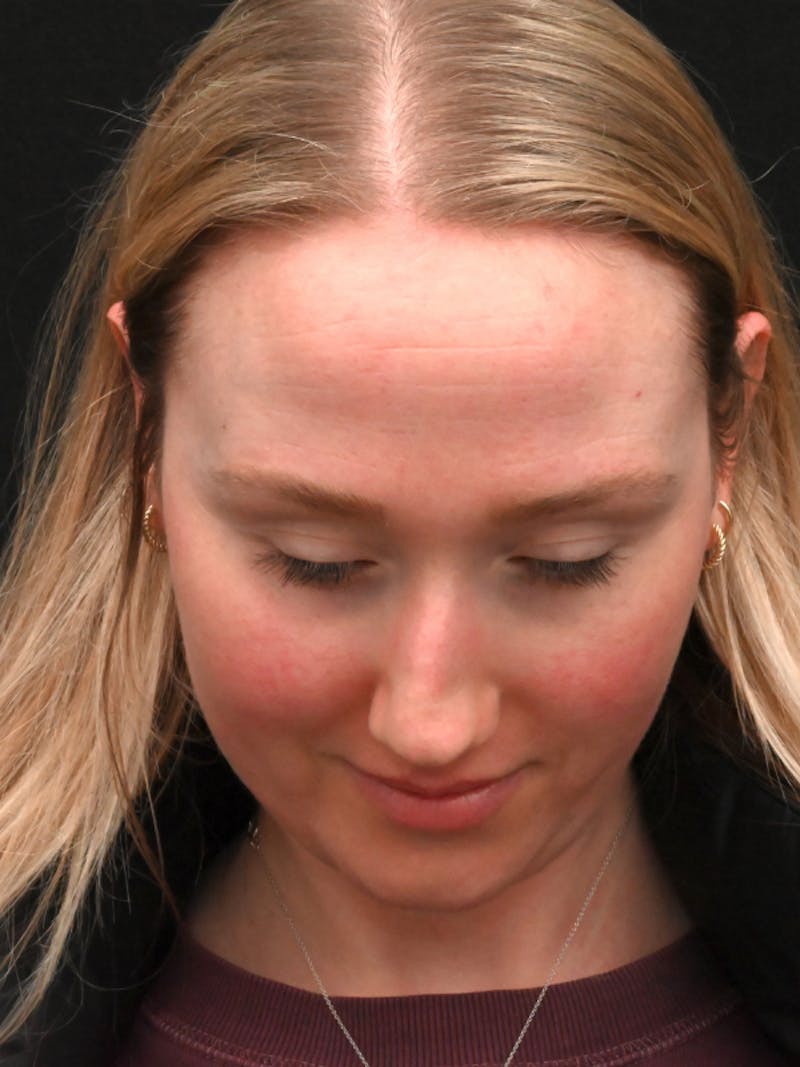 Rhinoplasty Before & After Gallery - Patient 504197 - Image 15