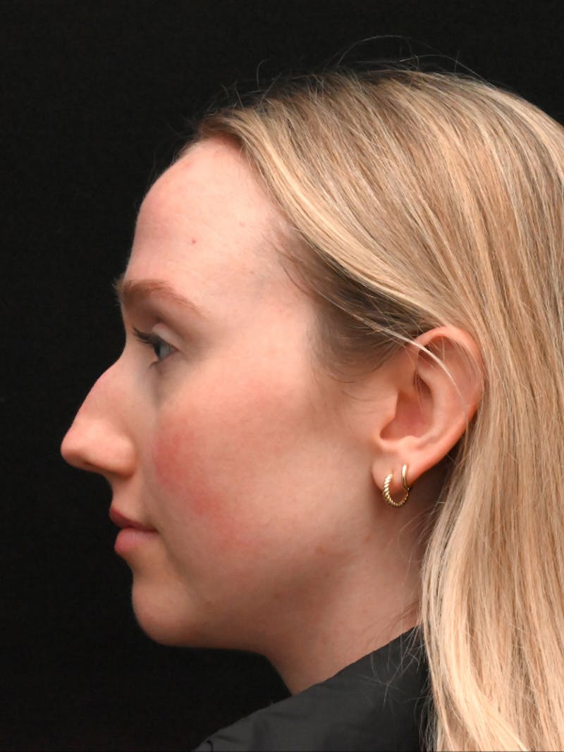 Rhinoplasty Before & After Gallery - Patient 504197 - Image 5