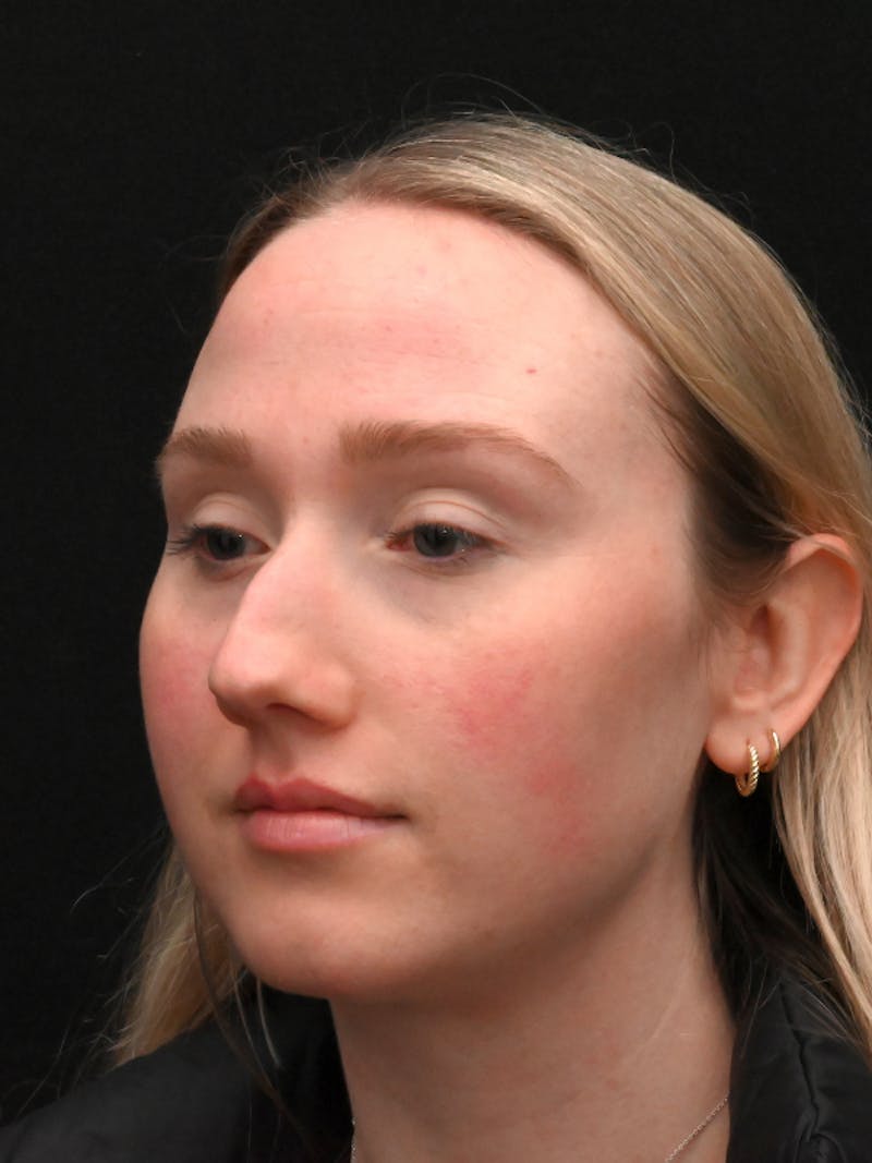 Rhinoplasty Before & After Gallery - Patient 504197 - Image 3
