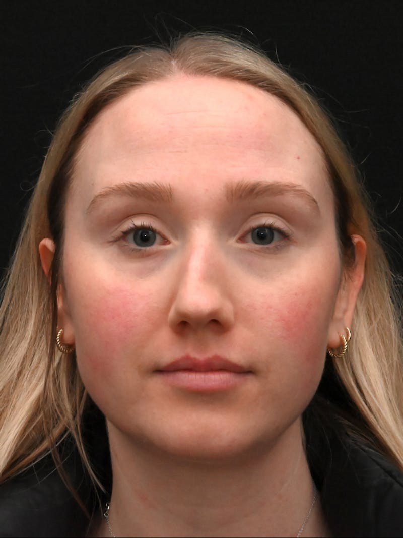 Rhinoplasty Before & After Gallery - Patient 504197 - Image 1