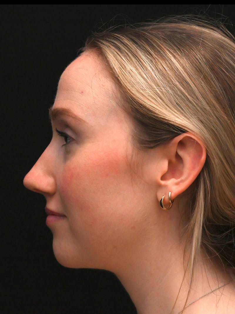 Rhinoplasty Before & After Gallery - Patient 504197 - Image 6