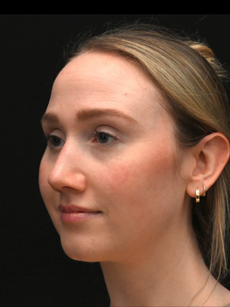 Rhinoplasty Before & After Gallery - Patient 504197 - Image 4