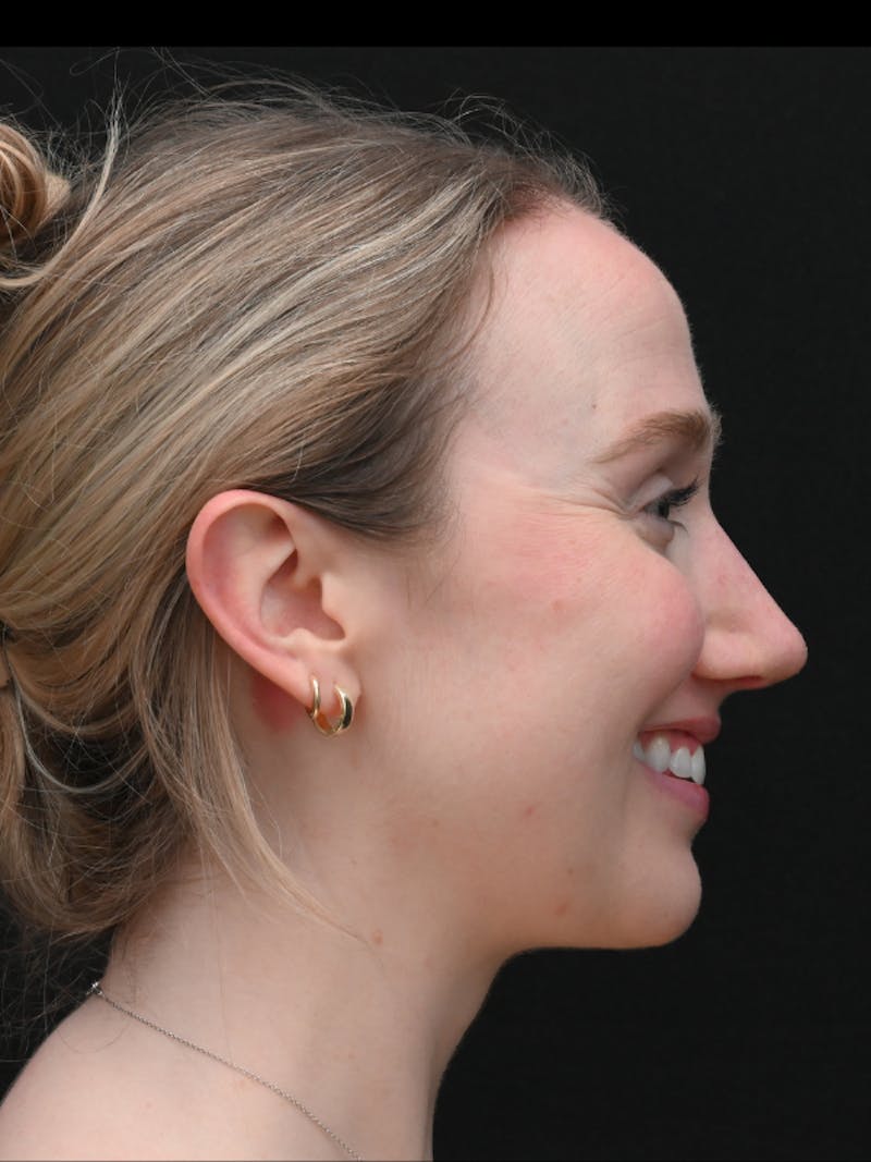 Rhinoplasty Before & After Gallery - Patient 504197 - Image 12