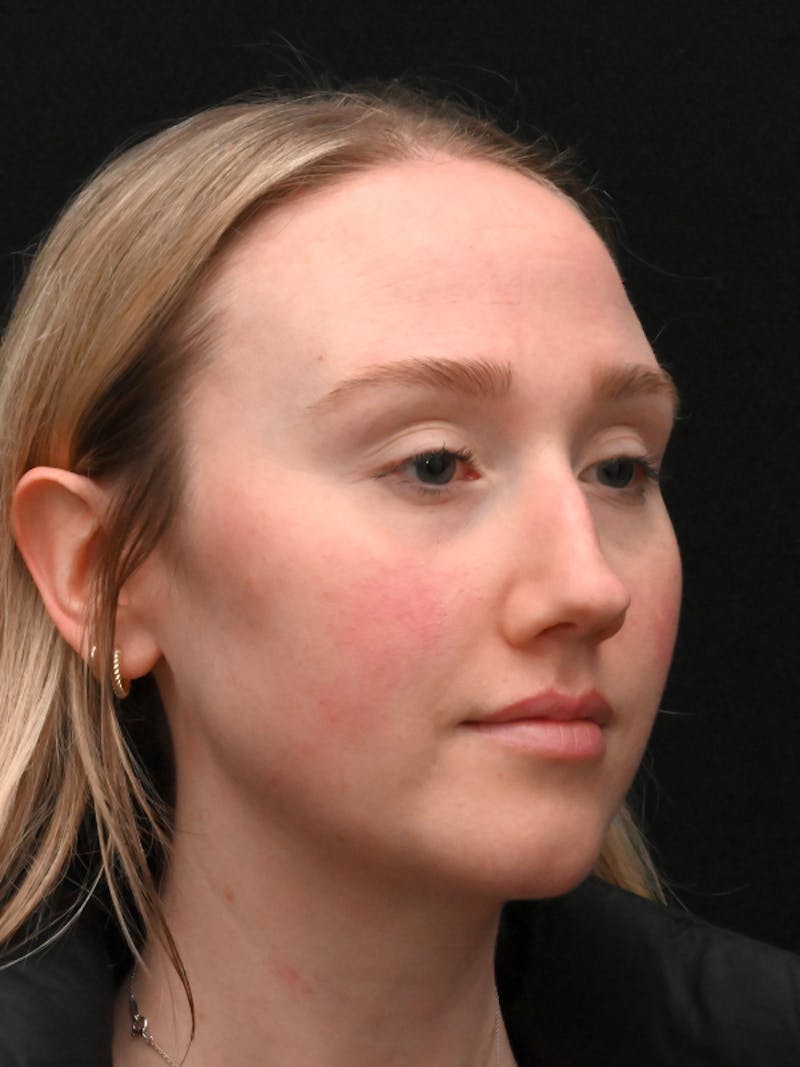 Rhinoplasty Before & After Gallery - Patient 504197 - Image 7