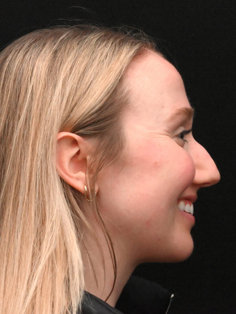 Rhinoplasty Before & After Gallery - Patient 504197 - Image 11