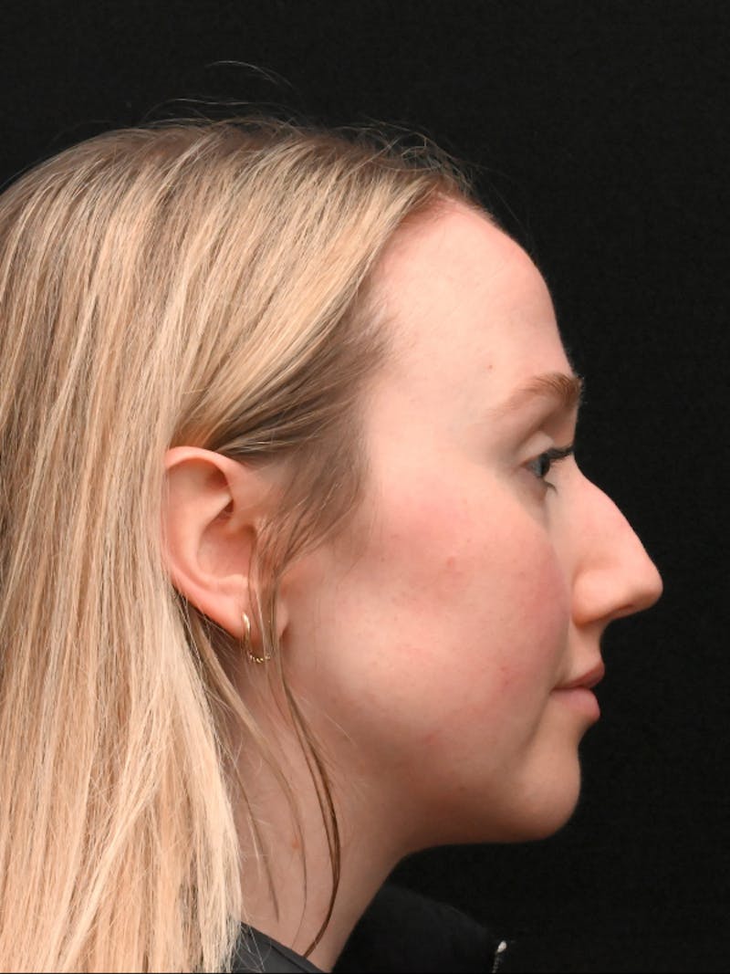 Rhinoplasty Before & After Gallery - Patient 504197 - Image 9
