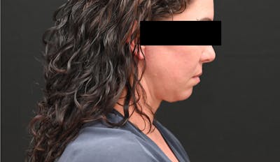 Deep Plane Facelift & Neck Lift Before & After Gallery - Patient 278512 - Image 2