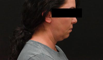 Deep Plane Facelift & Neck Lift Before & After Gallery - Patient 278512 - Image 1