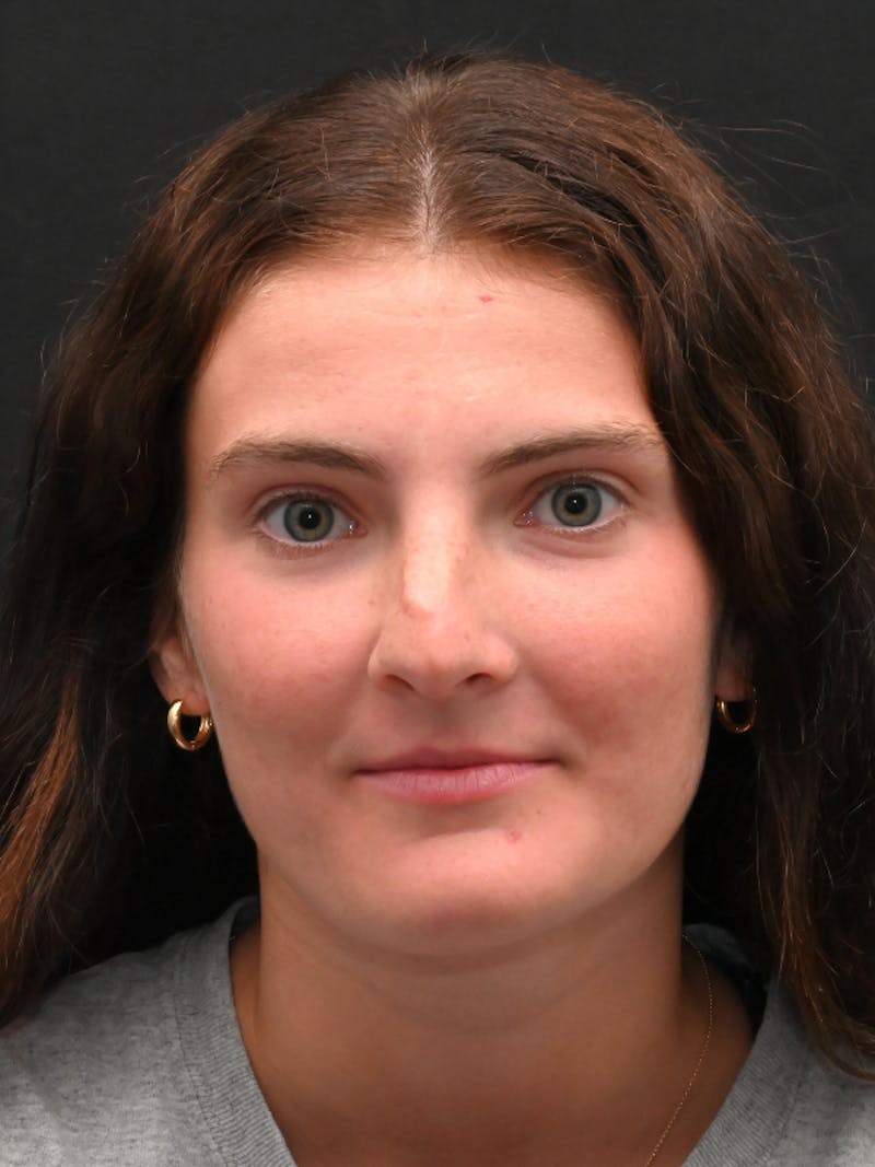 Rhinoplasty Before & After Gallery - Patient 256855 - Image 9
