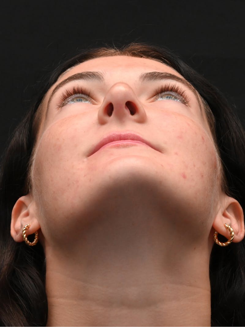 Rhinoplasty Before & After Gallery - Patient 256855 - Image 12
