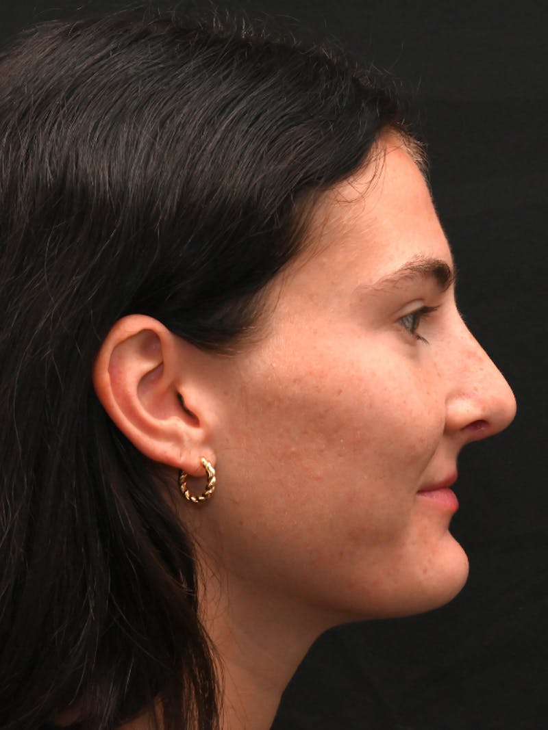 Rhinoplasty Before & After Gallery - Patient 256855 - Image 2
