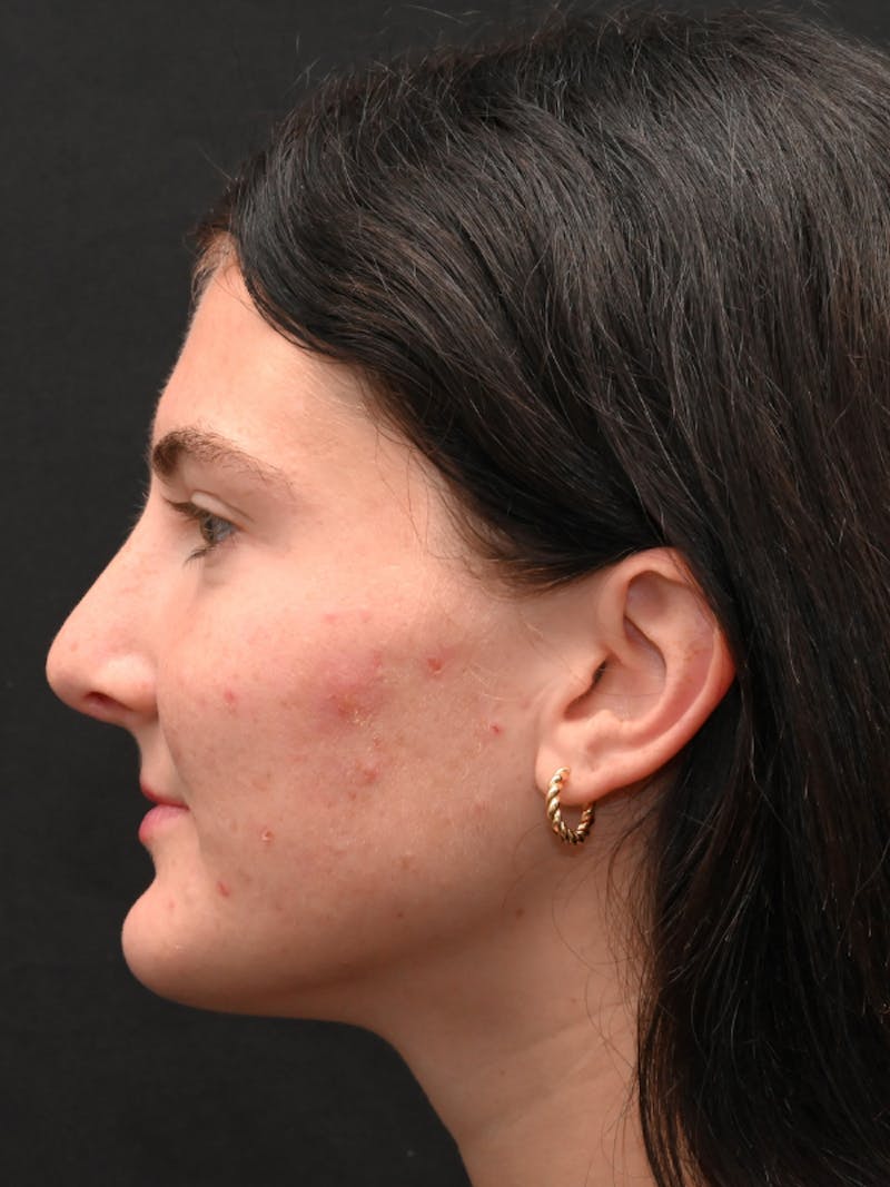 Rhinoplasty Before & After Gallery - Patient 256855 - Image 6