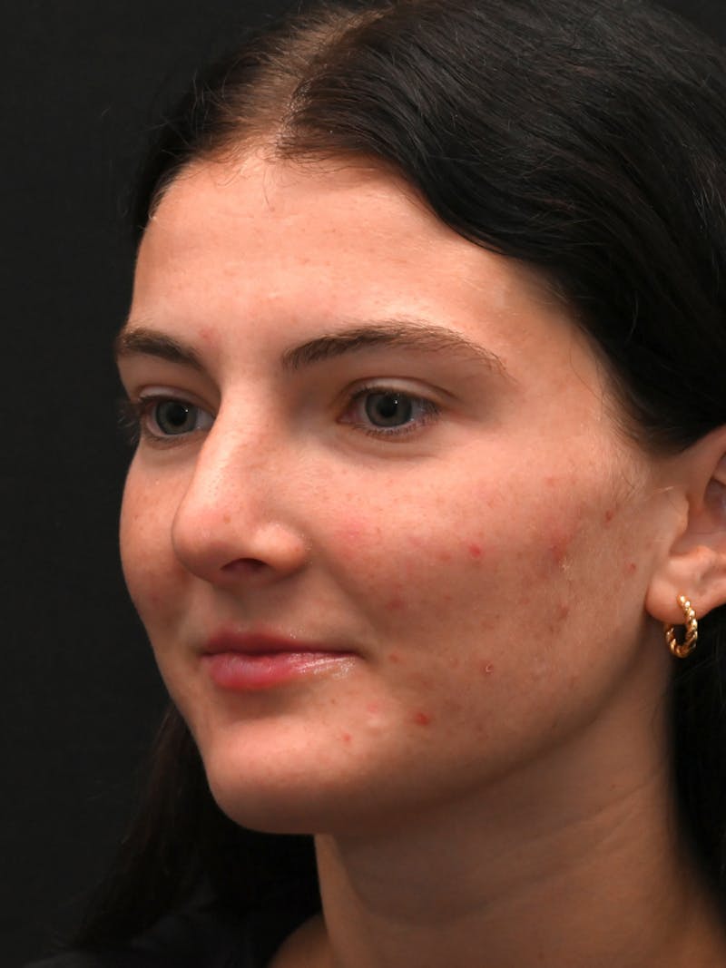 Rhinoplasty Before & After Gallery - Patient 256855 - Image 8