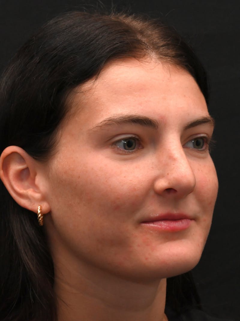 Rhinoplasty Before & After Gallery - Patient 256855 - Image 4