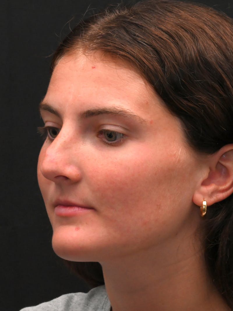 Rhinoplasty Before & After Gallery - Patient 256855 - Image 7