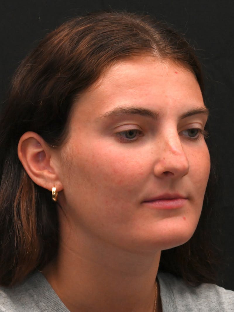 Rhinoplasty Before & After Gallery - Patient 256855 - Image 3