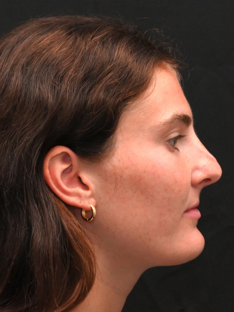 Rhinoplasty Before & After Gallery - Patient 256855 - Image 1