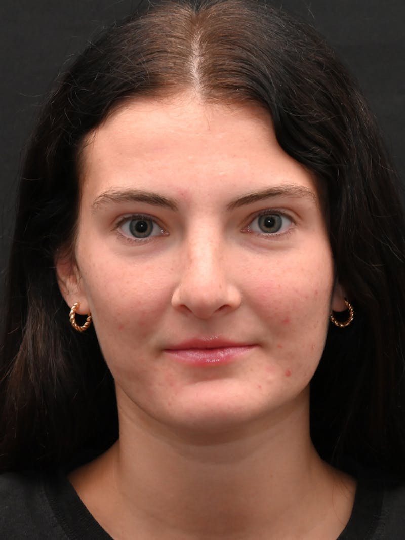 Rhinoplasty Before & After Gallery - Patient 256855 - Image 10