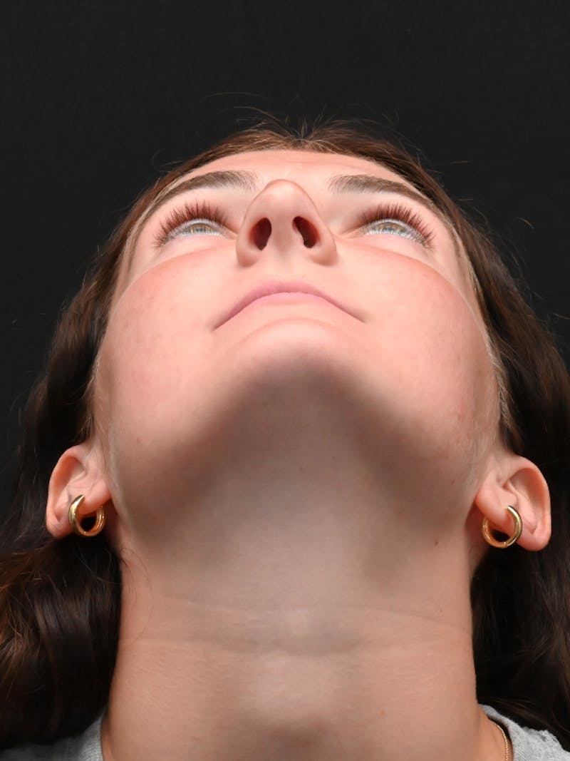 Rhinoplasty Before & After Gallery - Patient 256855 - Image 11