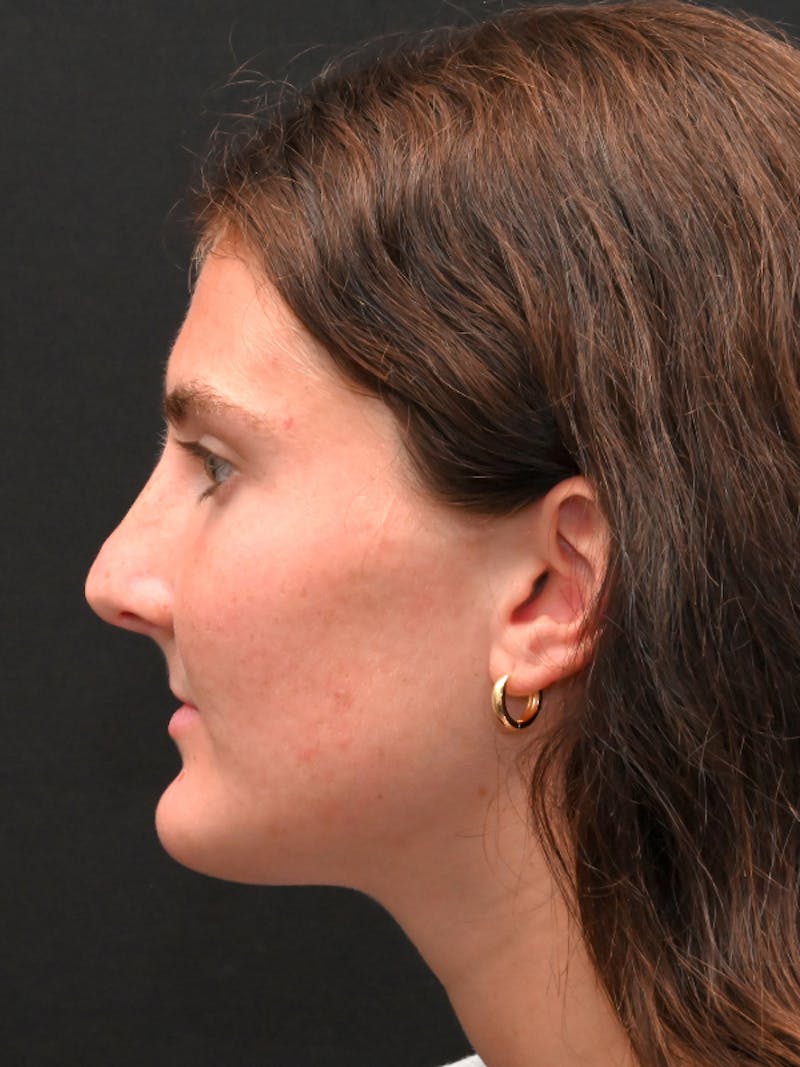 Rhinoplasty Before & After Gallery - Patient 256855 - Image 5