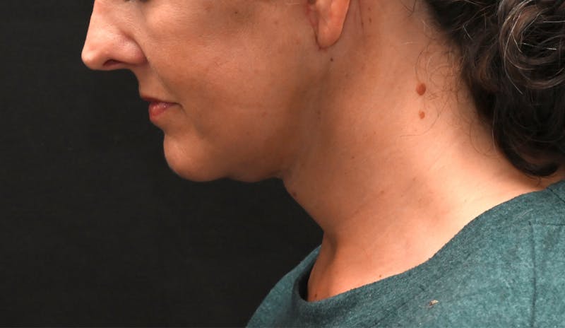 Deep Plane Facelift & Neck Lift Before & After Gallery - Patient 187105 - Image 12