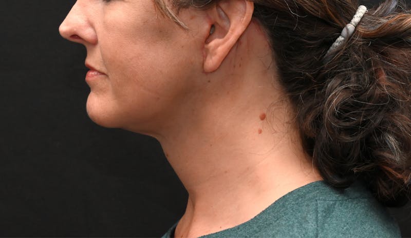 Deep Plane Facelift & Neck Lift Before & After Gallery - Patient 187105 - Image 10