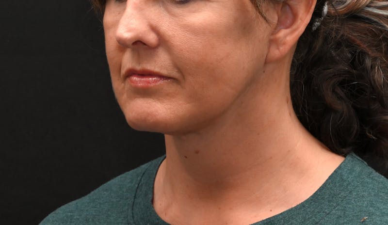 Deep Plane Facelift & Neck Lift Before & After Gallery - Patient 187105 - Image 8