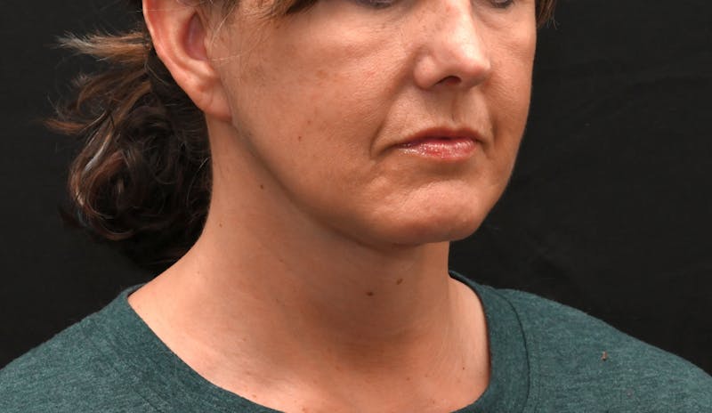 Deep Plane Facelift & Neck Lift Before & After Gallery - Patient 187105 - Image 6